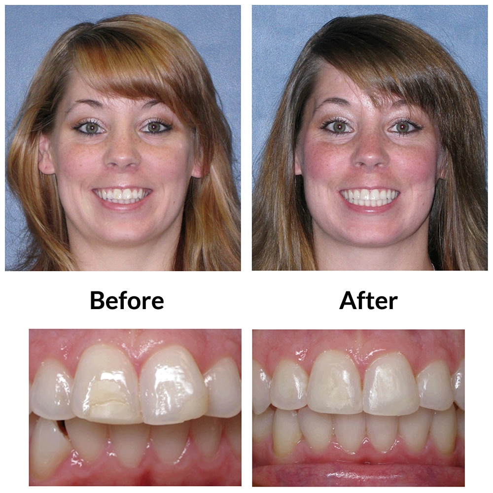 Adult 2 Invisalign Before and After