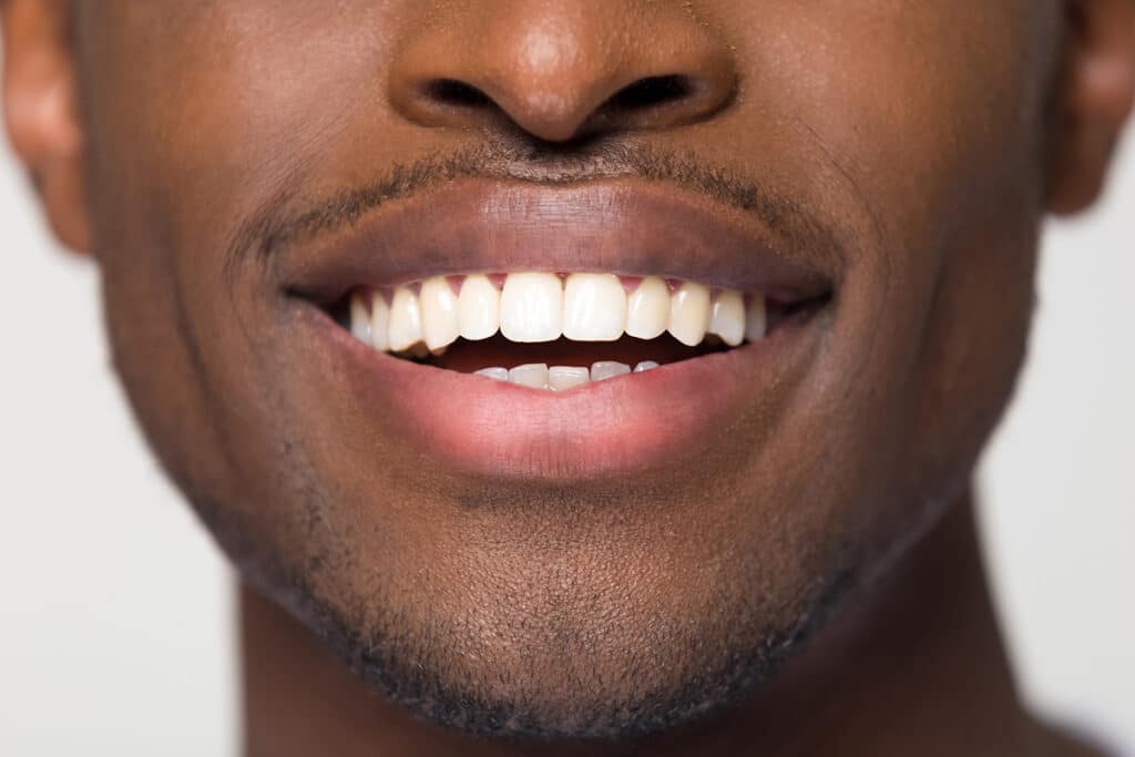 Can Teeth Whitening Damage Your Enamel? Dentist-Approved Facts