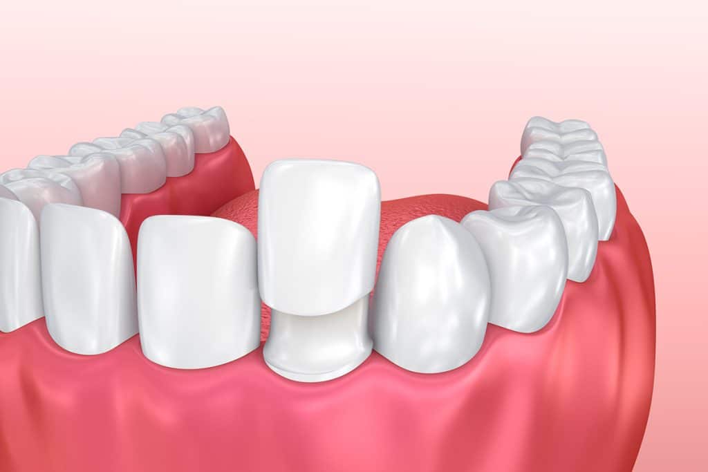 How Long Do Veneers Last?