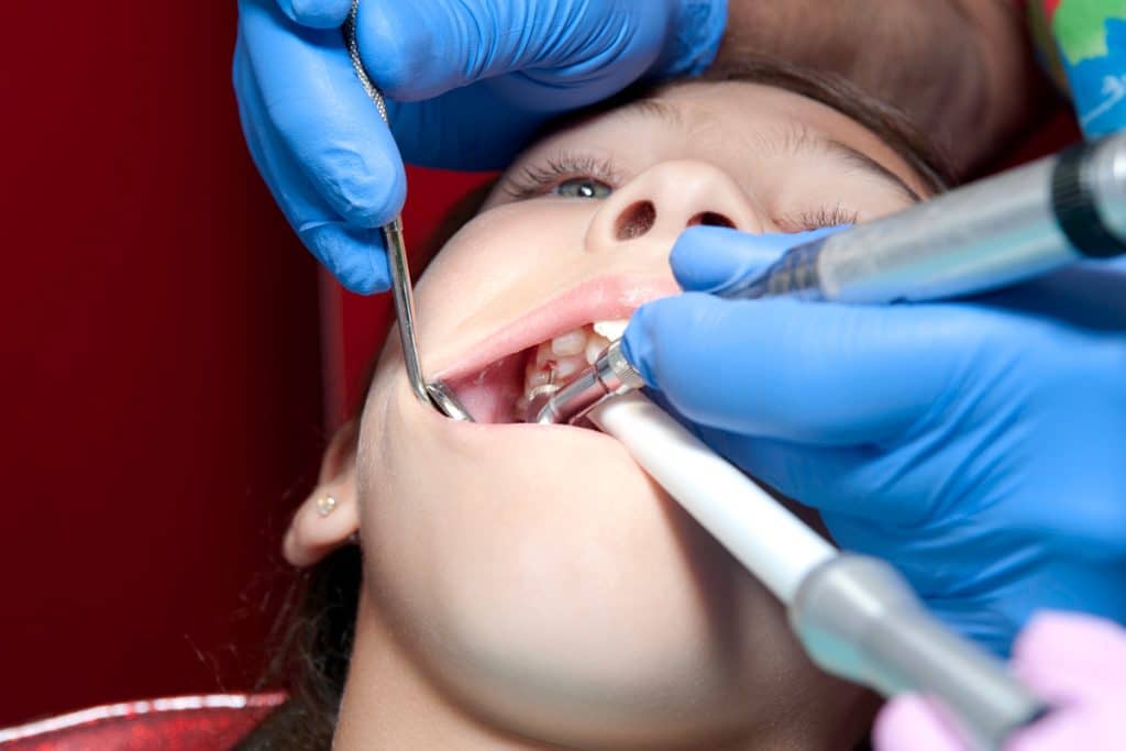 How Long Does a Root Canal Last?