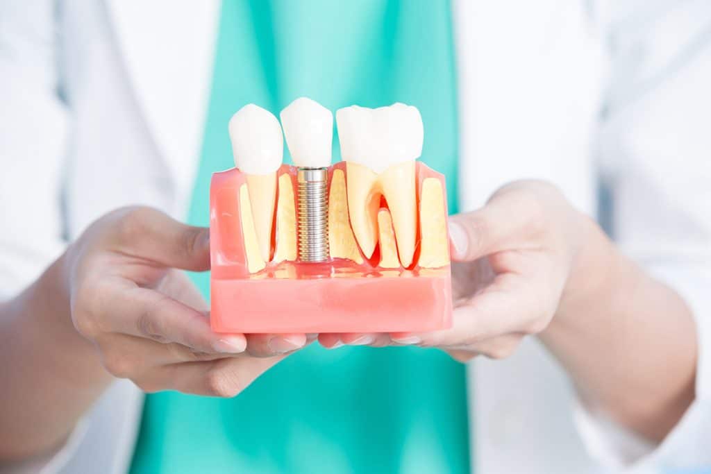 How to Take Care of Dental Implants