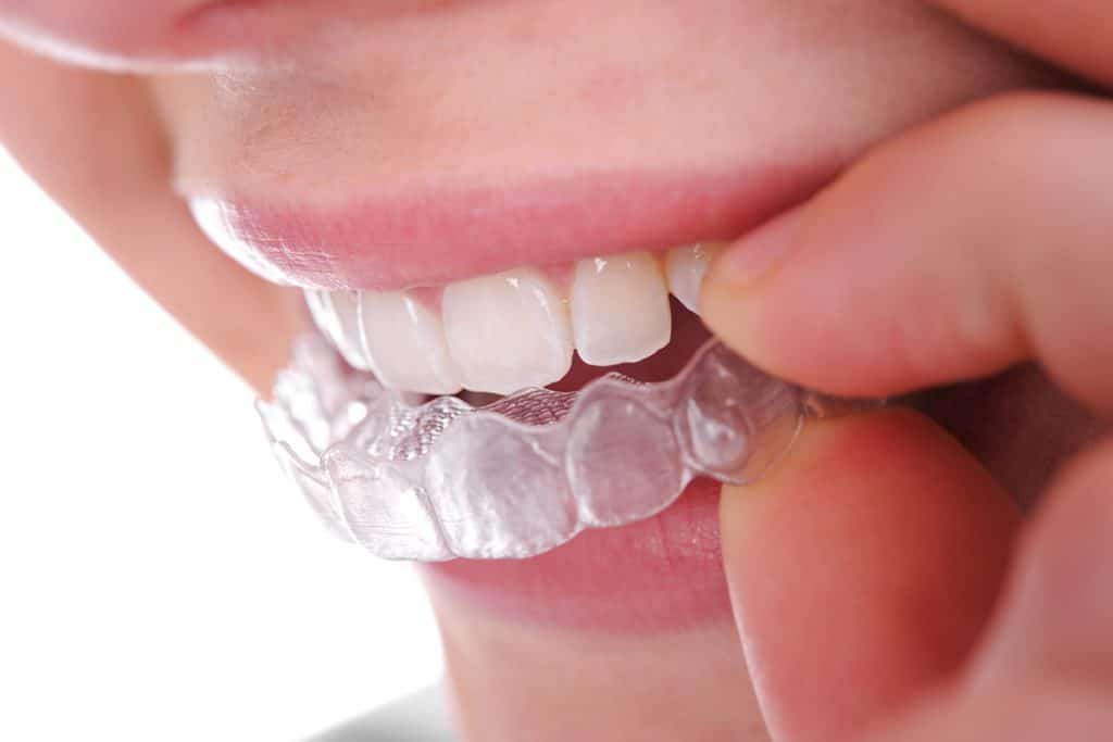 Invisalign Attachments: What Are They and Why Might You Need Them?