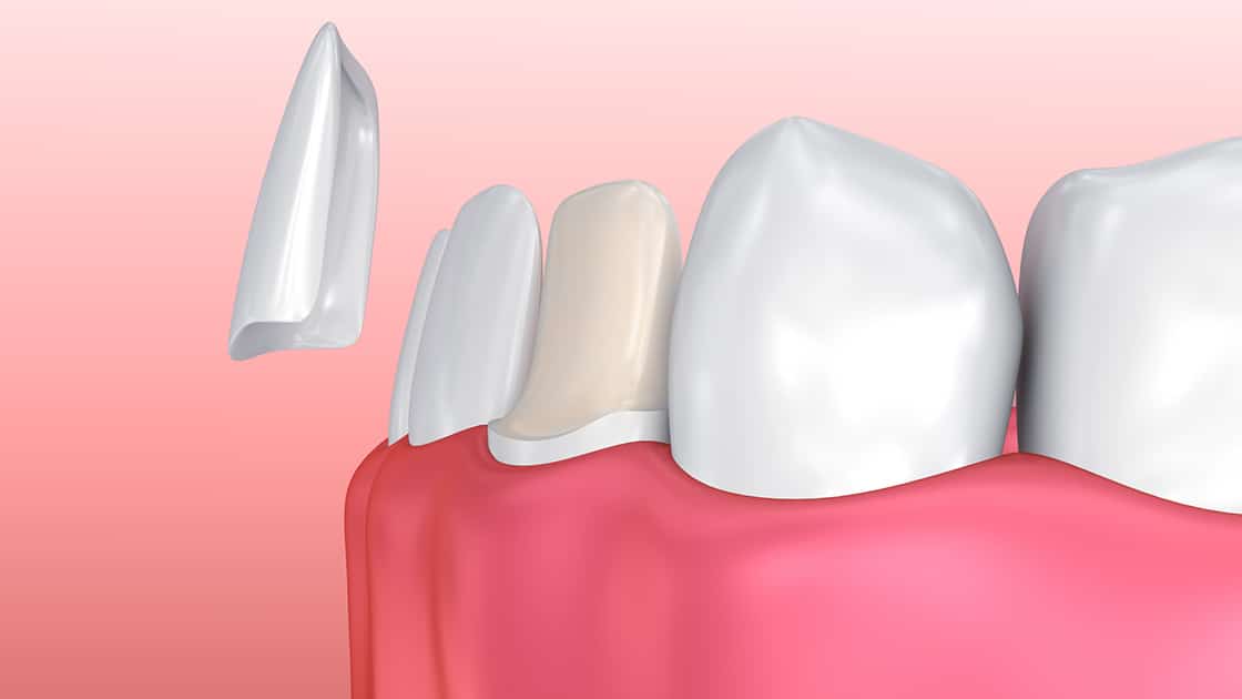 Dental Veneers