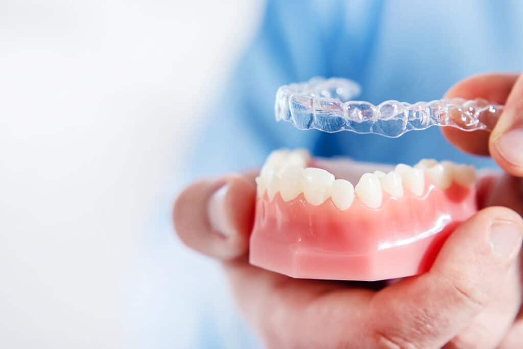 What Happens If You Skip a Day of Invisalign?
